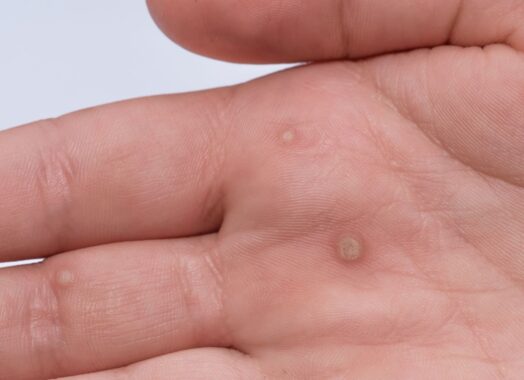 How to Detect a Wart and What to Do About Them