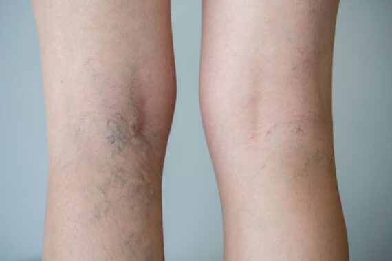 How to Treat Spider Veins Before Swimsuit Season