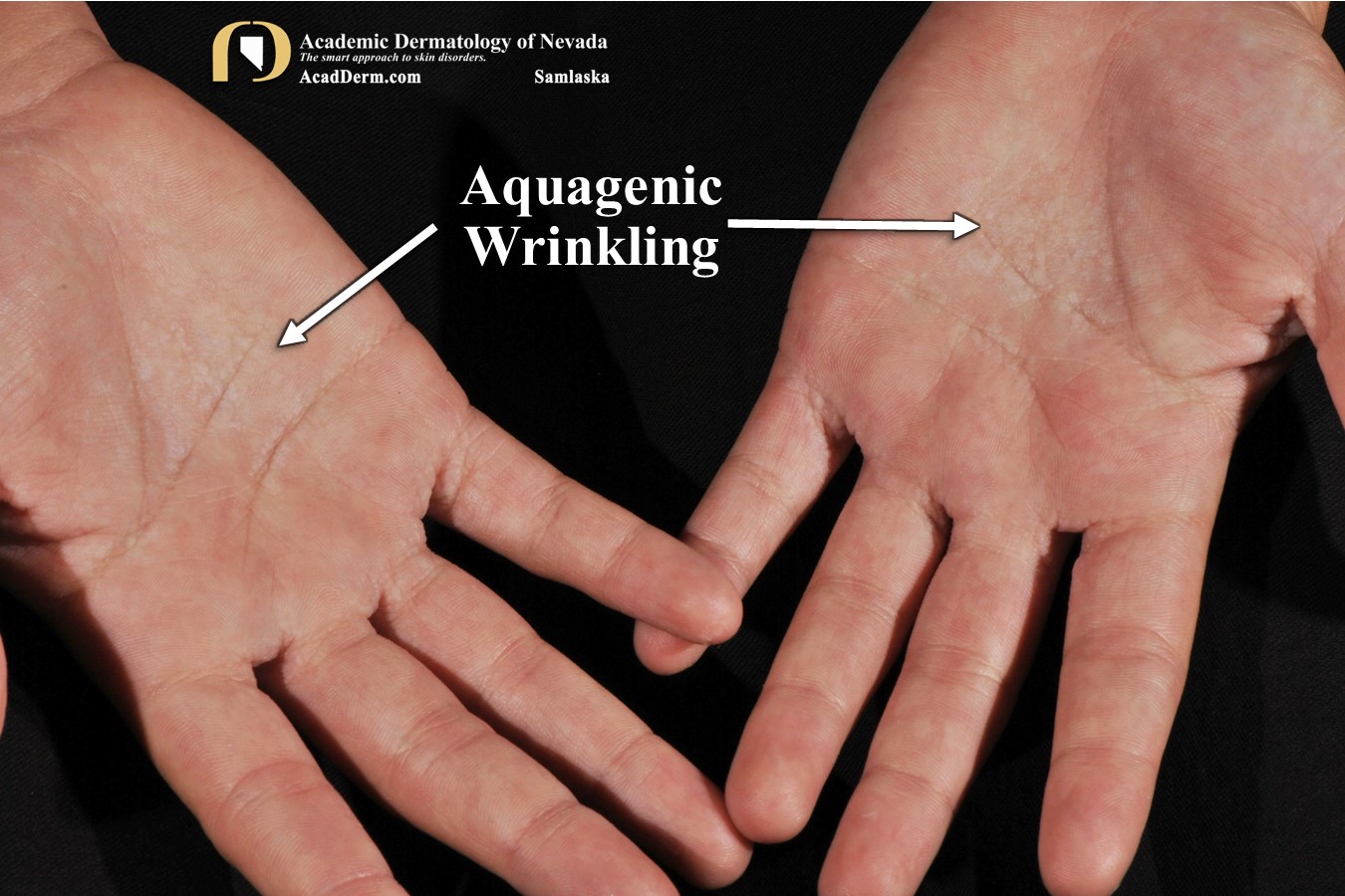 Aquagenic Wrinkling:  It burns…