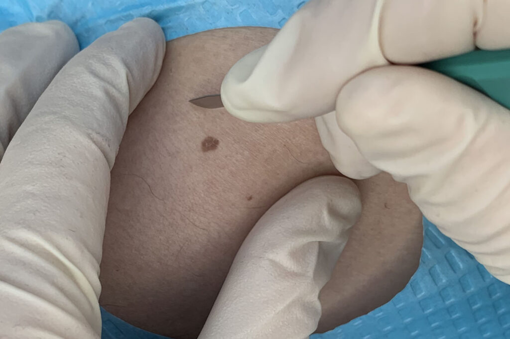 excisional surgery_OK - Academic Dermatology of Nevada