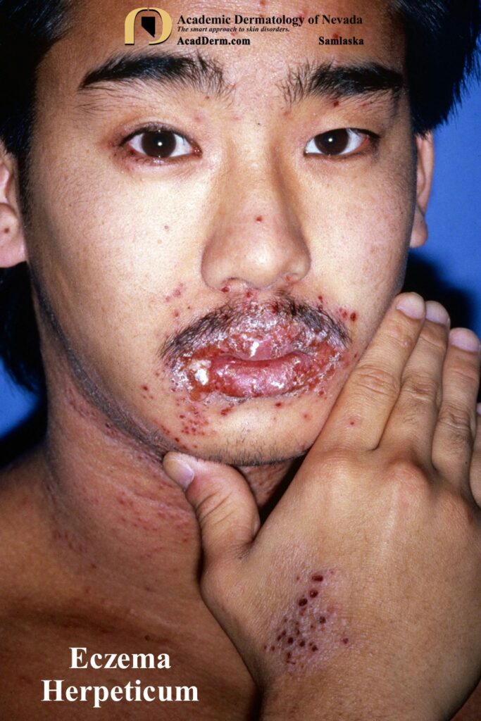 EczemaHerpeticumSamlaska1 - Academic Dermatology of Nevada