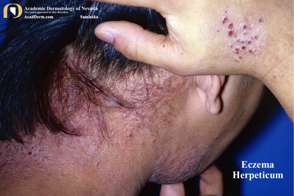 EczemaHerpeticumSamlaska2a - Academic Dermatology of Nevada