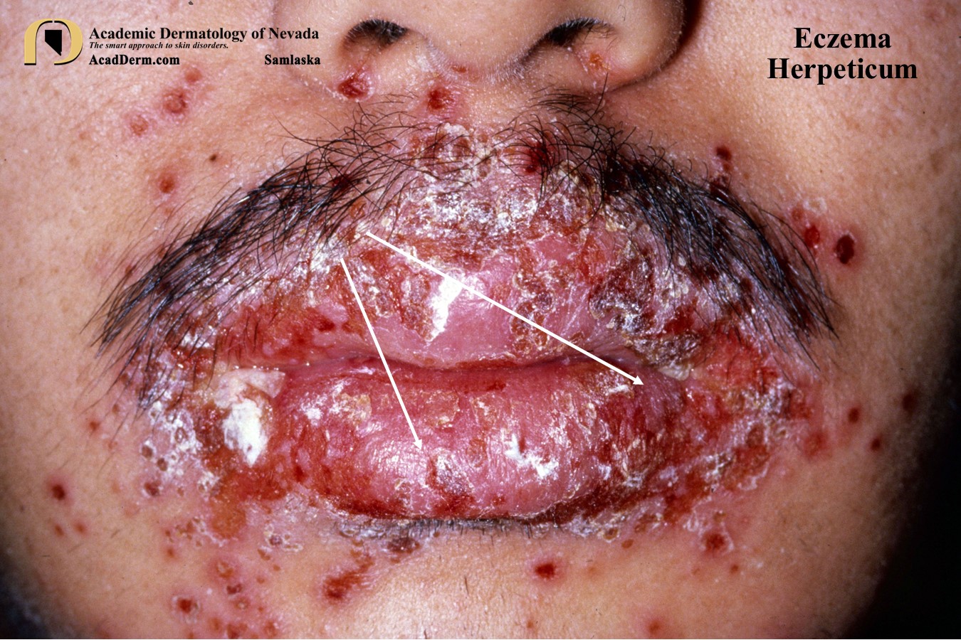 Eczema Herpeticum:  Kaposi Varicelliform Eruption…