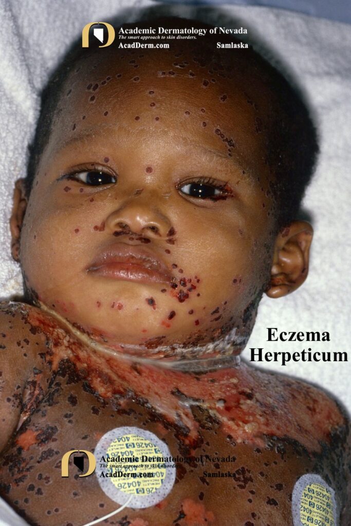 EczemaHerpeticumSamlaska4 - Academic Dermatology of Nevada