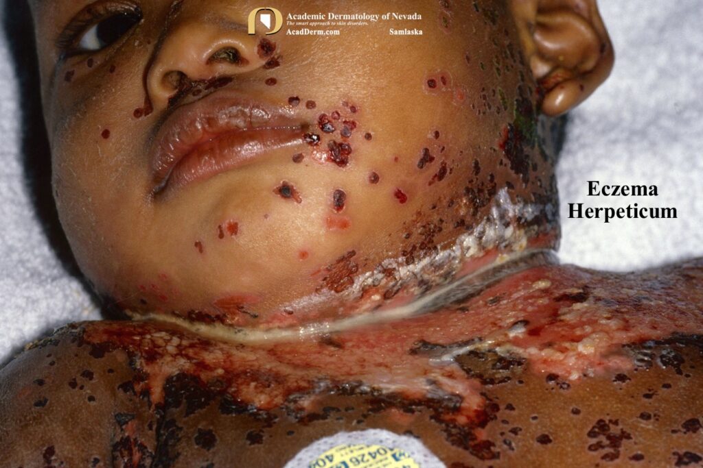 EczemaHerpeticumSamlaska5 - Academic Dermatology of Nevada