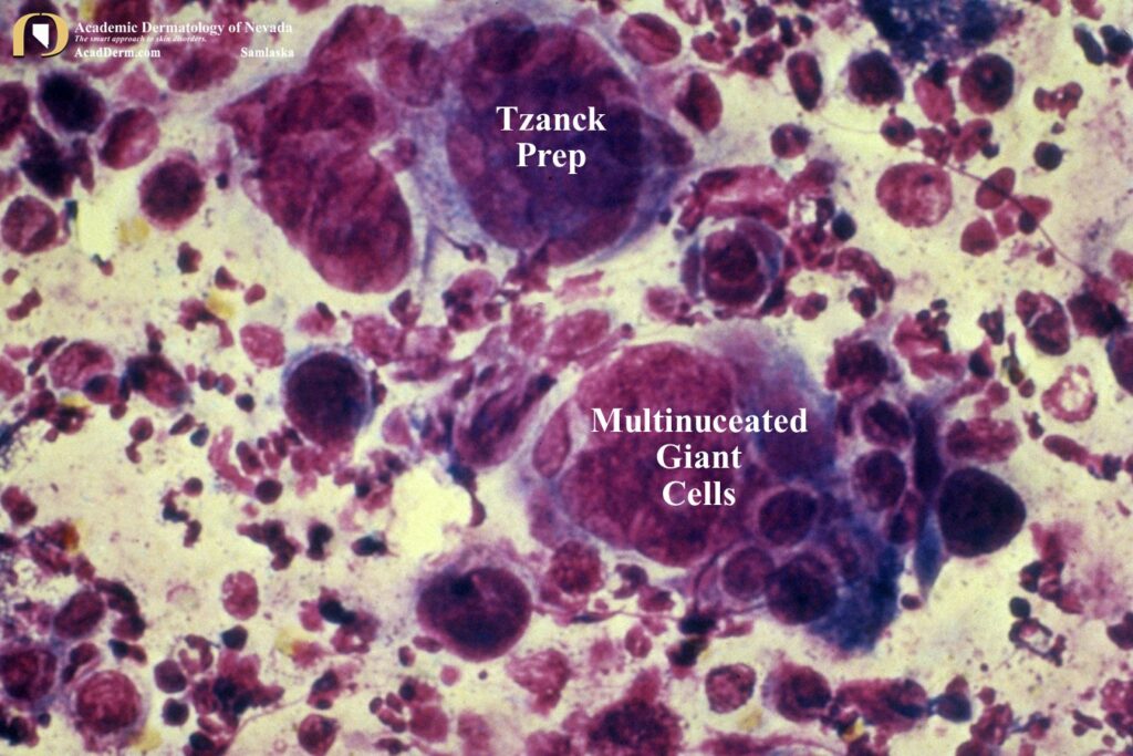 EczemaHerpeticumSamlaska7 - Academic Dermatology of Nevada