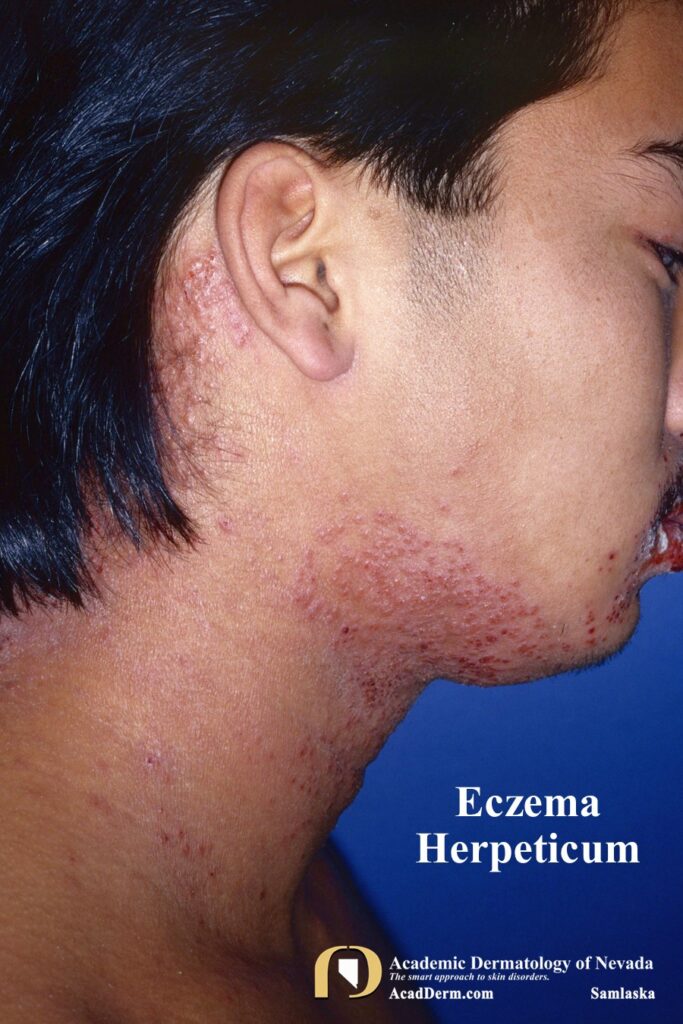 EczemaHerpeticumSasmlaska2 - Academic Dermatology of Nevada
