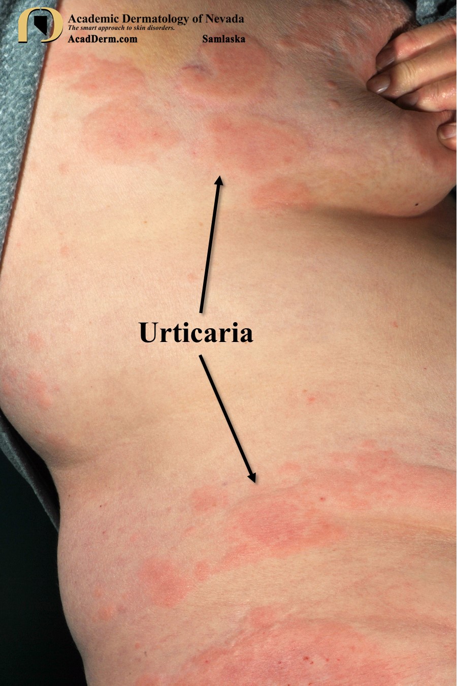 Urticaria:  Acute and Chronic Hives…