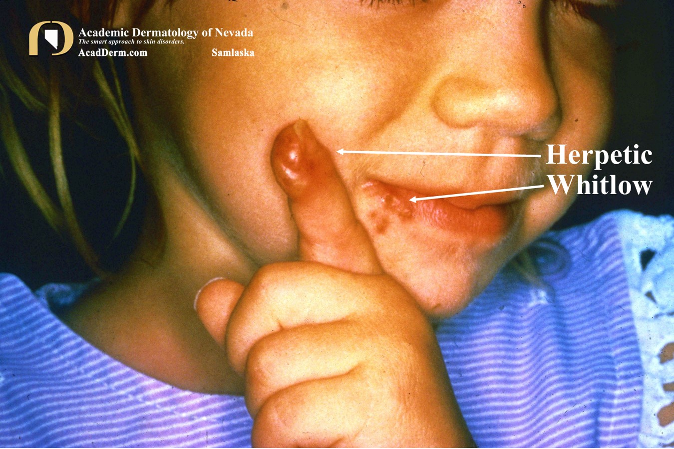 Herpetic Whitlow:  Herpes Manuum…