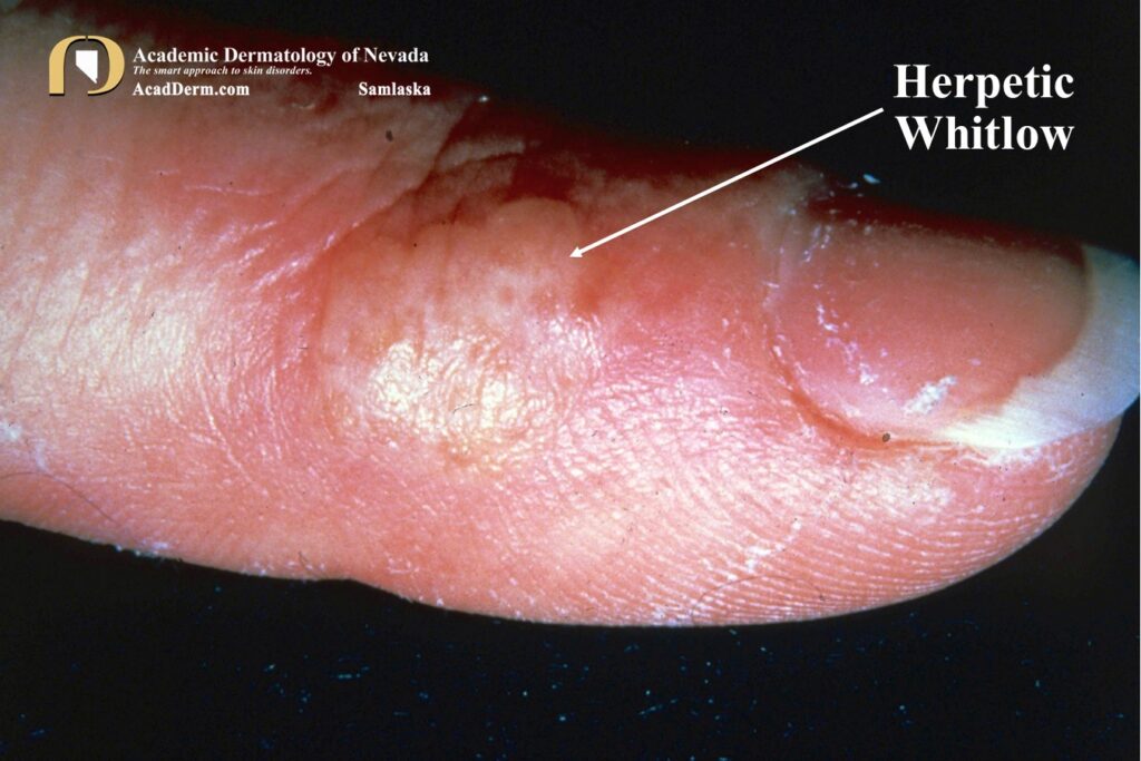 HerpeticWhitlow3 - Academic Dermatology of Nevada