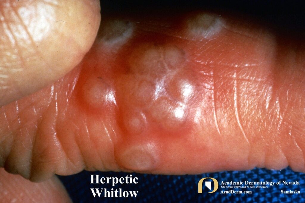 HerpeticWhitlow4 - Academic Dermatology of Nevada