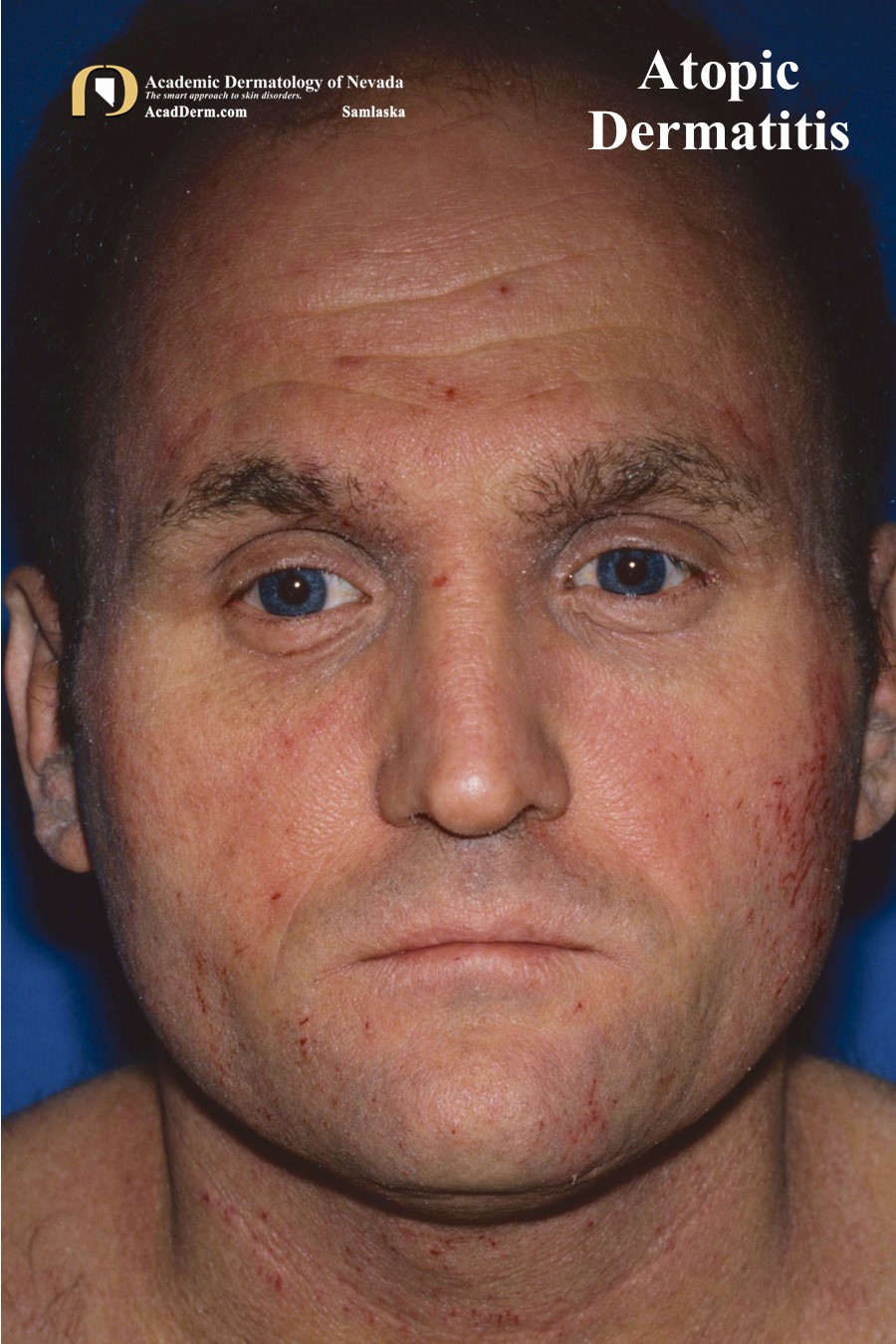 Atopic Dermatitis:  Allergic eczema…