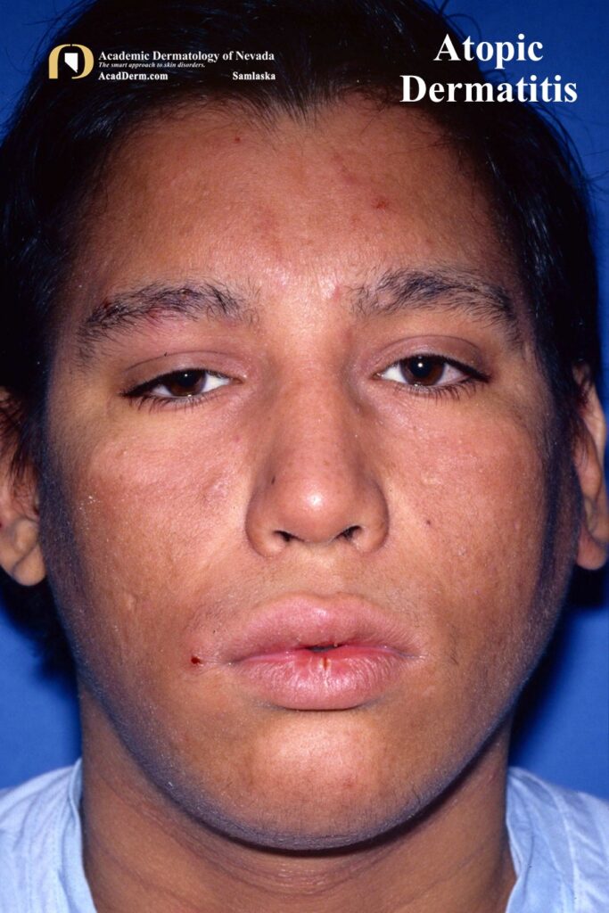 AtopicDerm2 - Academic Dermatology of Nevada