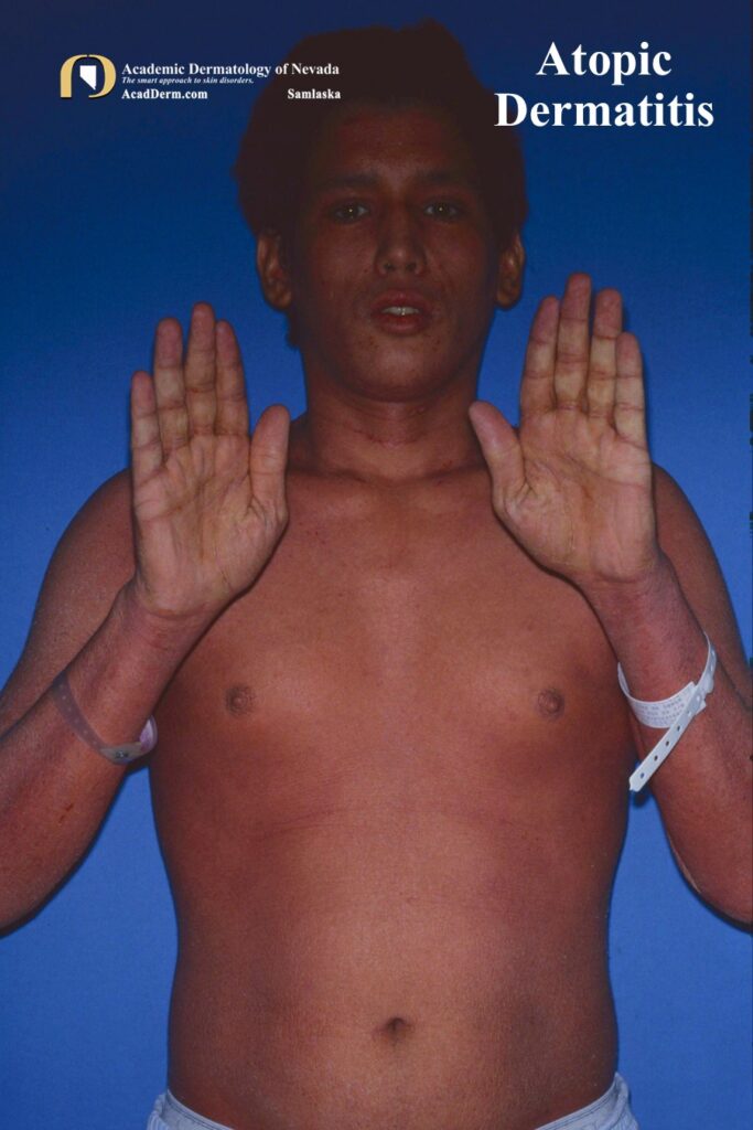 AtopicDerm3 - Academic Dermatology of Nevada