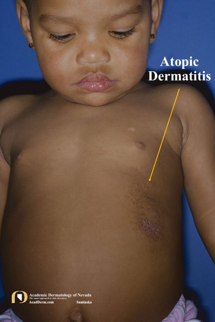 AtopicDerm4 - Academic Dermatology of Nevada