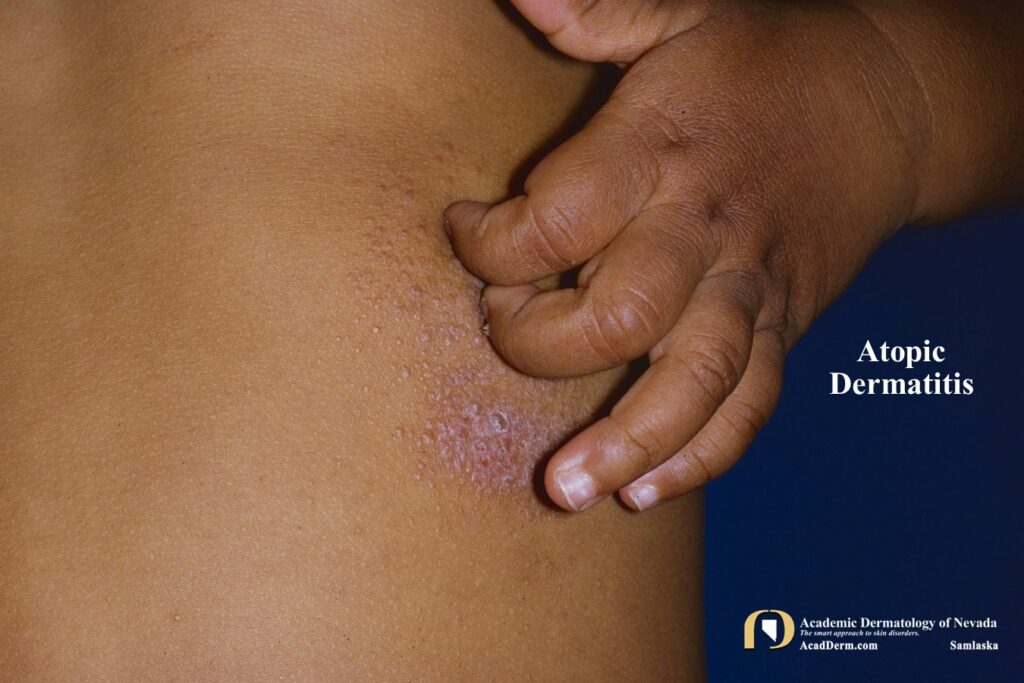 AtopicDerm5 - Academic Dermatology of Nevada