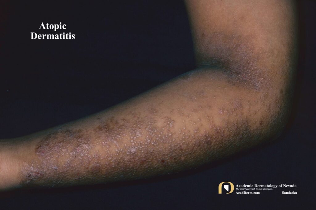 AtopicDerm6 - Academic Dermatology of Nevada