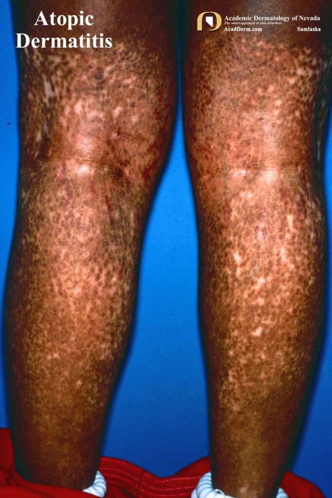 AtopicDerm7 - Academic Dermatology of Nevada