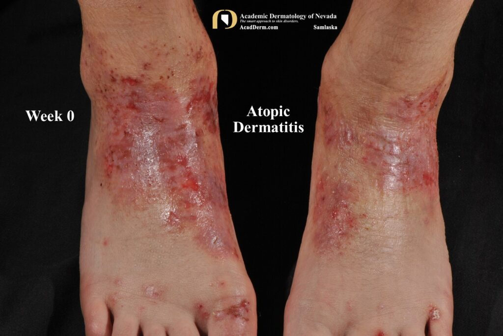 AtopicDermWK0Samlaska1 - Academic Dermatology of Nevada