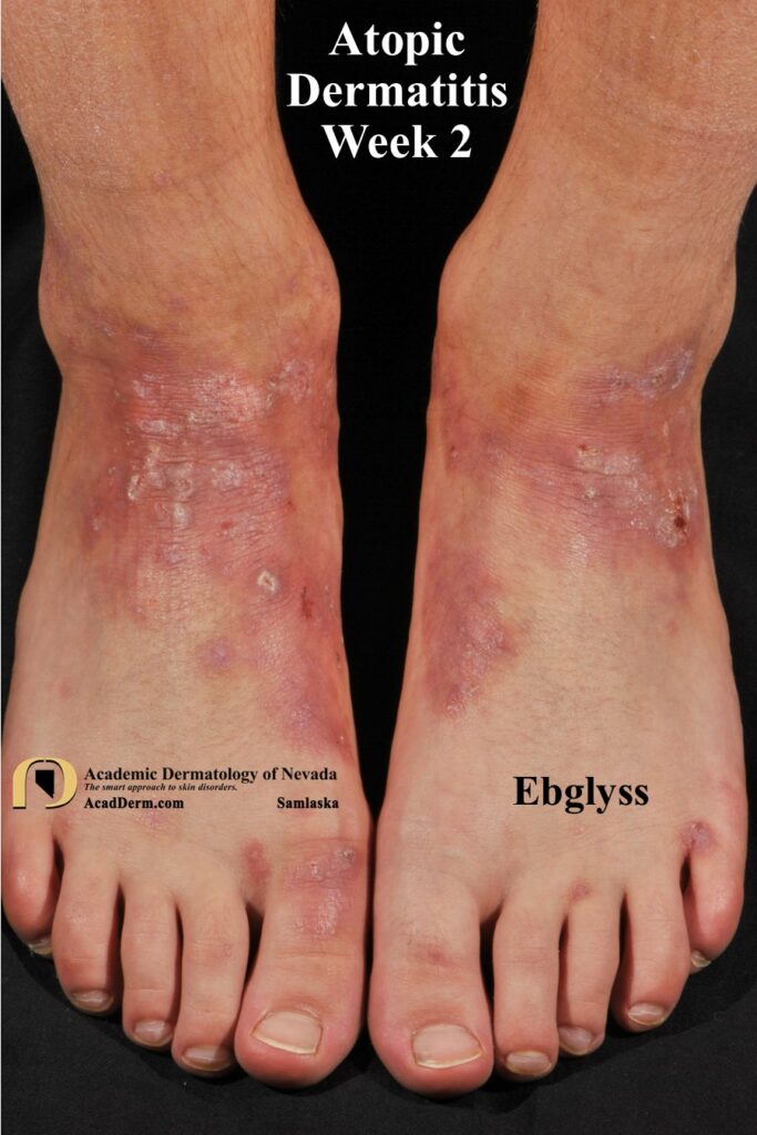 AtopicDermWK2Samlaska1 - Academic Dermatology of Nevada